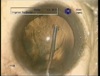 Corticocapsular Adhesions