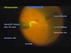 Membrane Peeling in Ischemic Retina