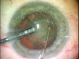 1.8mm Coaxial MICS with Stellaris
