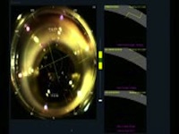 Toric IOL in the Setting of a Ruptured Posterior Capsule