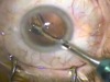 IOL Insertion: Keep in Touch
