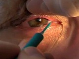 Snug Plug Placement Procedure