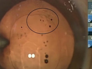 Converting a Tear into a Continuous Posterior Capsulorrhexis