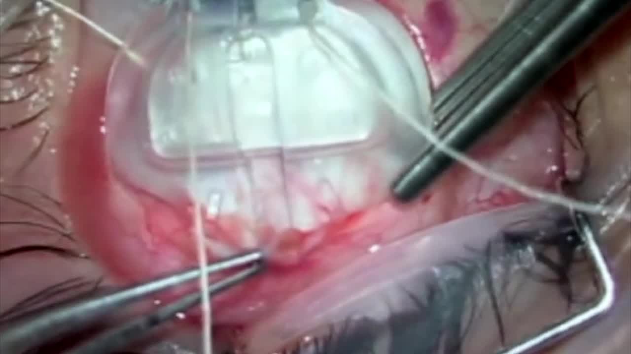 Tube Erosion Treatment After Ahmed Glaucoma Valve Implantation 