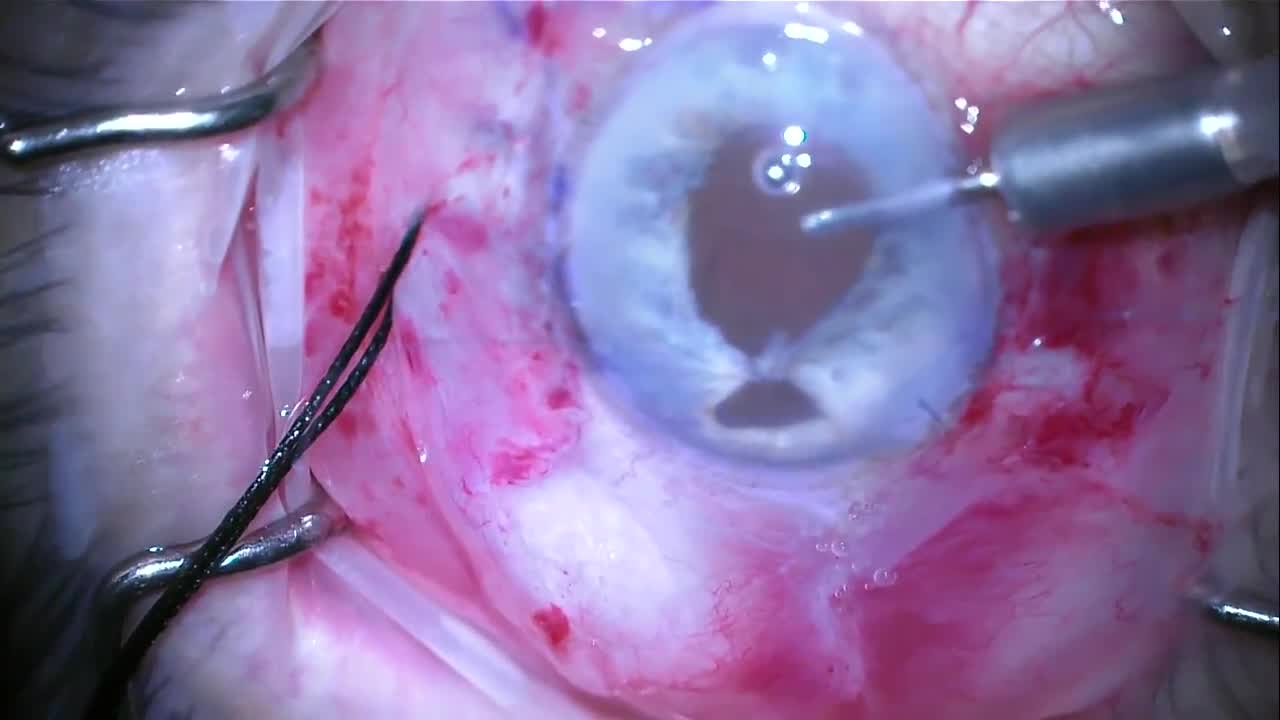 Pupilloplasty Using the Single-Pass Four-Throw Technique (SFT) and Glued IOL