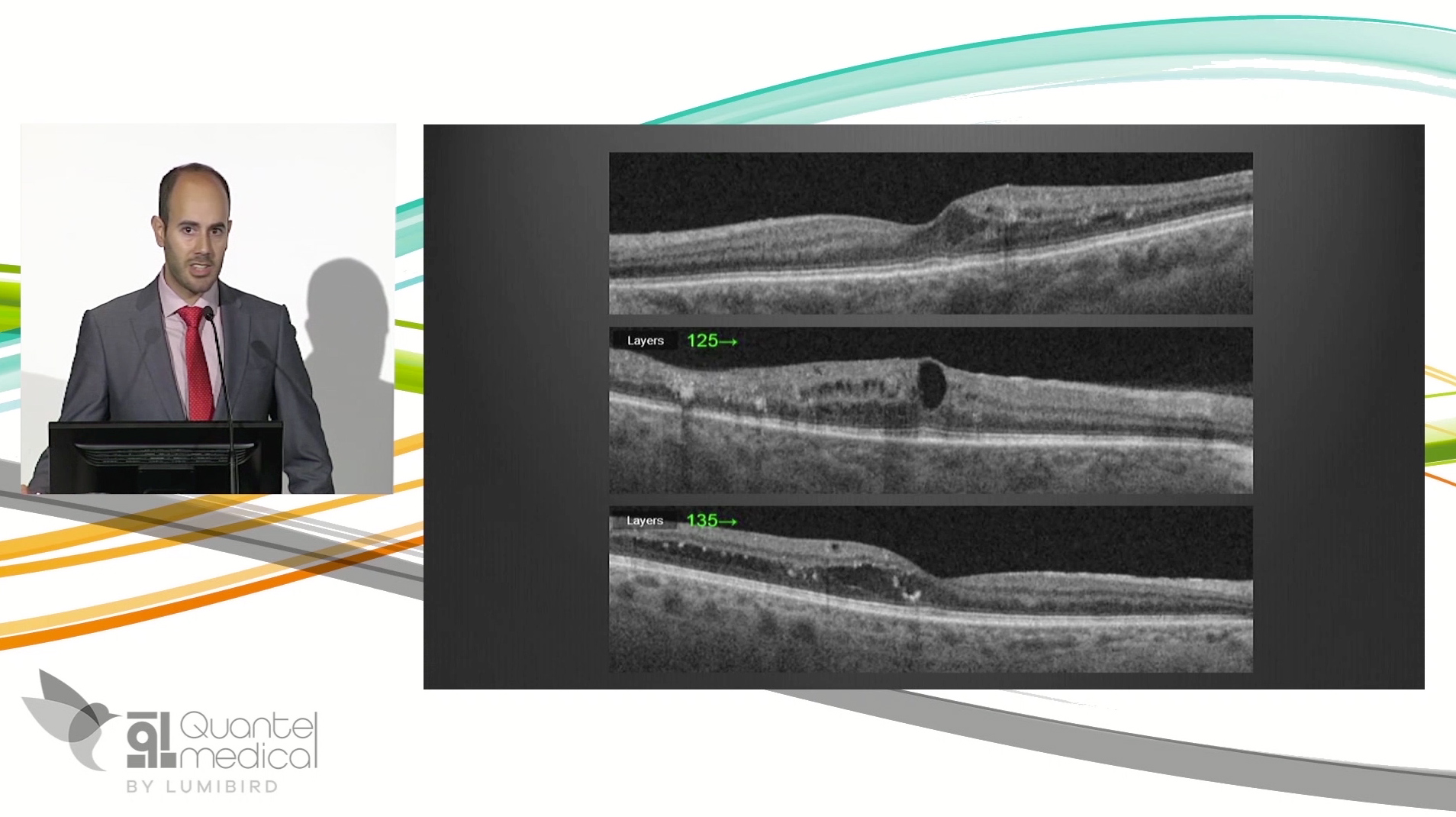 Fovea-Involving DME: Reasons for the subliminal approach