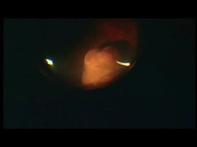 23-25G Chandelier Assisted Biopsy of Choroidal Mass