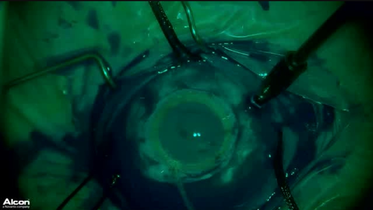 The 21st Century Scleral Buckle: Heads Up With a Chandelier