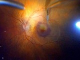 Implantation of a Free Transplant of RPE and Choroid for Wet AMD