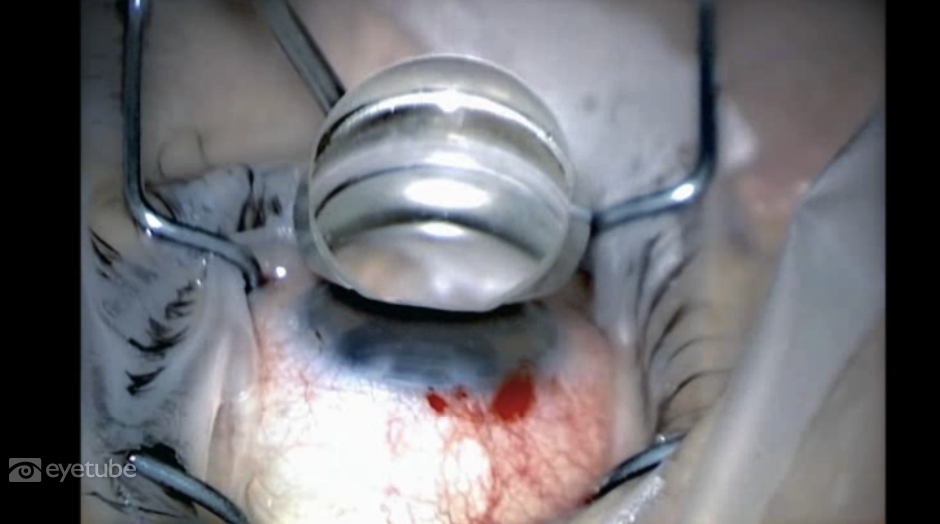 Glaukos Symposia Part 8