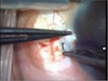 Vertical Glued IOL for Lens Coloboma