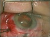 Scleral Rupture 