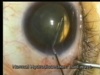 Intraoperative Capsular Block 