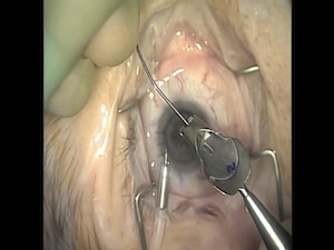 Artisan Lens Explantation, Phacoemulsification With PC IOL Insertion and DSAEK for Bullous Keratopathy
