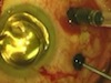 Modified Suturing Technique for in Tranconjunctival Pars-plana Vitrectomy Surgery 