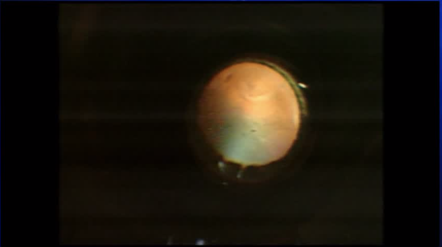 Suprachoroidal Buckle