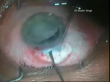 Why All Cataract Surgeons Should Learn Manual SICS Too