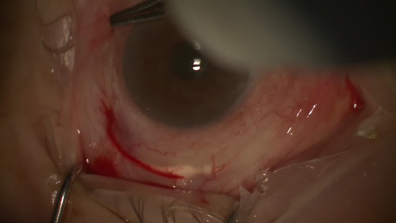 Endoscopic Vitrectomy for Anterior PVR With Hypotony 