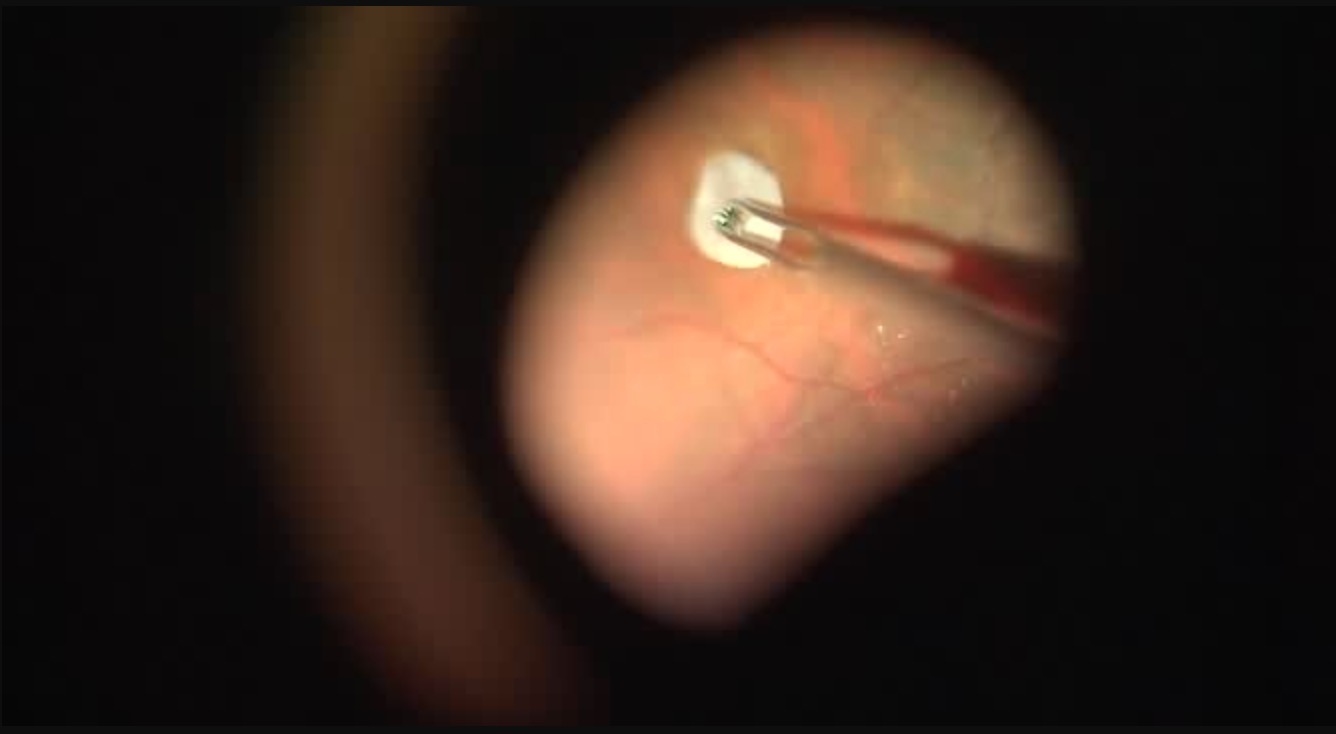 [3-D] Amniotic Membrane Placement for Repair of Recurrent Macular Hole