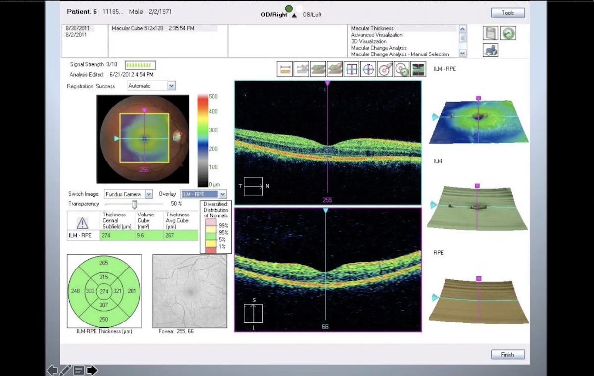 Utilizing OCT-A in Clinical Practice