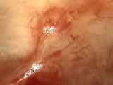 Scleral Buckling Procedure