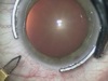 Micro Incision Phaco