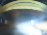 Pupillary block