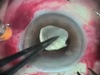 P. Acnes Endophthalmitis