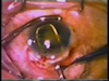The Pupil Snap Sign of Posterior Capsular Rupture