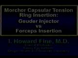 Morcher Capsular Tension Ring Insertion: Geuder Injector vs Forceps Insertion