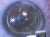 Irregular Flap Formation with Femto Laser