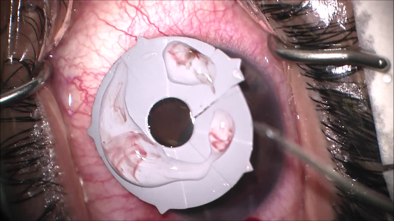 Sutureless Explanation of BrightOcular Cosmetic Color Iris Implant with One Cut Technique