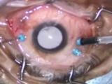 25-g Elevation of Posterior Hyaloid using Triesence Visualization