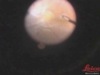 Acute PVR Following Uncomplicated Vitrectomy