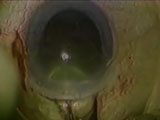 Small Incision ECCE, Bimanual Delivery