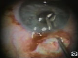 Sphincterotomies