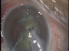 Mature Cataract