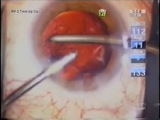 Routine Cataract Surgery with Soft Chop