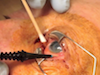 Management of Suspected Endogenous Endophthalmitis: Part 2