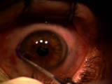 Performing LASIK