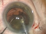 Pars Plana Vitreous Tap in Crowded Eye