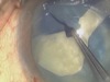 How to Prevent the Argentinian Flag Sign in Intumescent Cataracts