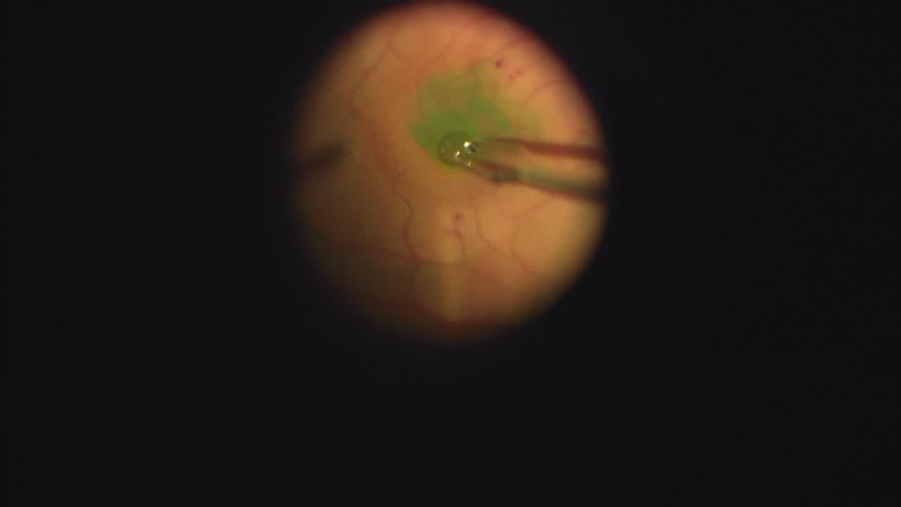 Macular Hole Closure With Autologous ILM and Autologous Serum