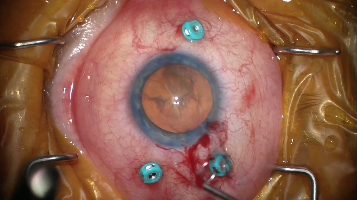 miLOOP Training: Temporal Two-handed Technique on Small Pupil Toric Multifocal Case