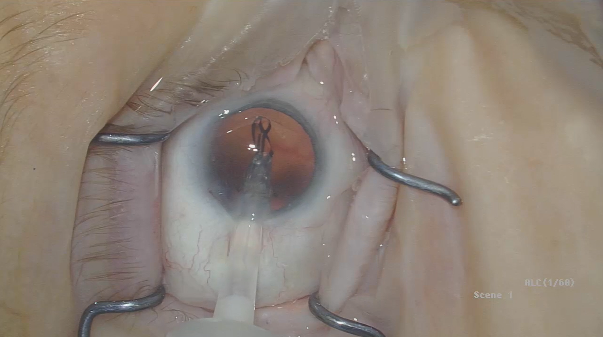 Daniel Bregman, MD, Demonstrates RayOne's 2-Step Preloaded IOL