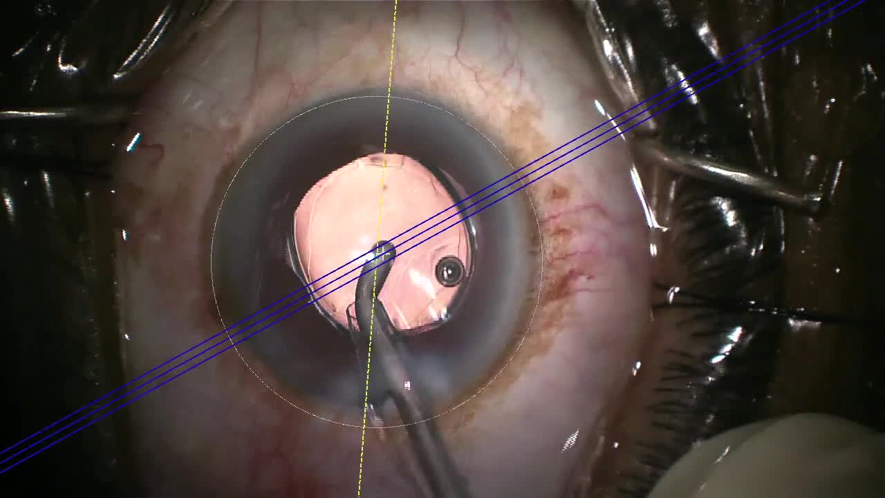 Envista Toric IOL With New Enhanced Material