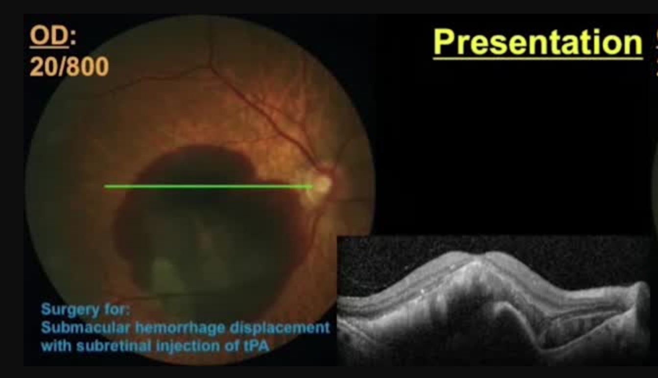 Subretinal Injection of tPA