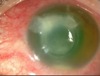 Microbial Keratitis Following ICRS Implantation