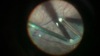 Macular Unfolding in Infants