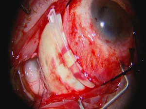 Macular Buckling 
